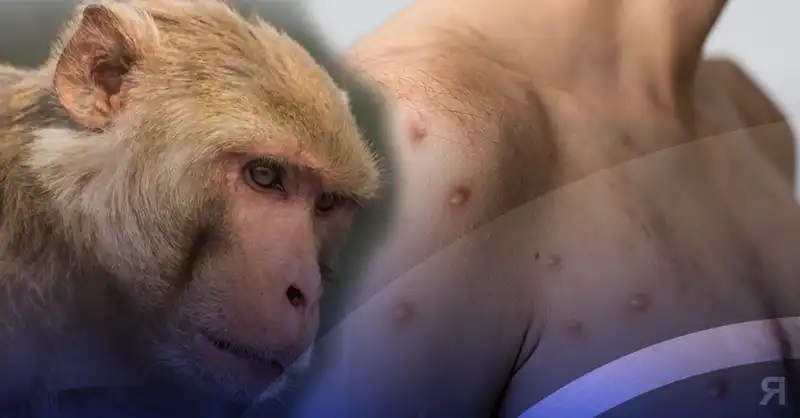 Photo of Cinco preguntas clave sobre la viruela del mono que ya registra casos en 15 países