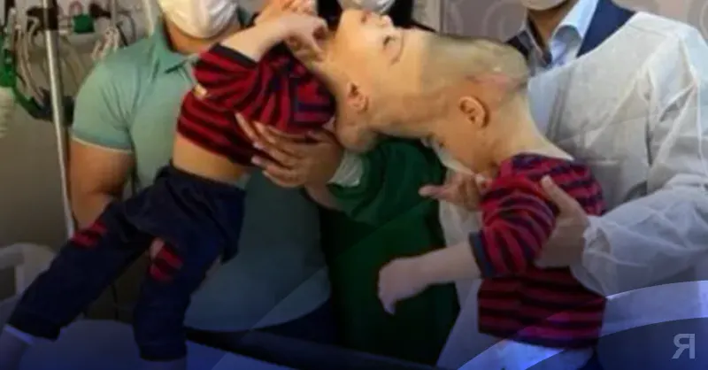 Photo of Separaron con éxito a bebés que estaban unidos por el cerebro
