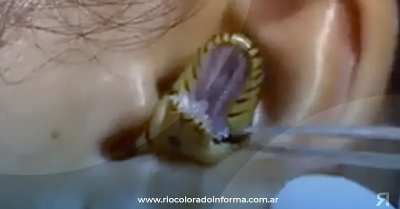 Photo of VIDEO: cirujano intenta sacar una serpiente viva de la oreja de una mujer